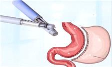 لاغری با «اوزمپیک» یا جراحی اسلیو و بای‌پس؟
