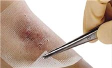 بهبود زخم و کنترل قند خون بیماران دیابتی با «نانوفیبرهای دارویی»