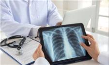 داروی حیاتی بیماران فیبروز ریوی تولید انبوه شد؛افزایش طول عمر تا 11سال