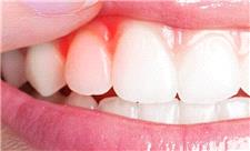 کیفیت خواب ضعیف، رهاورد بیماری‌های لثه