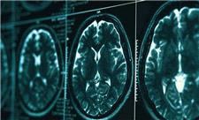 روشی در توقف بیماری آلزایمر کشف شد