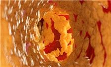 کاهش 58 درصدی کلسترول بد با یک داروی جدید