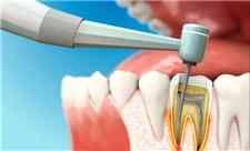 عصب‌کشی درد دارد اما سپر قلب‌تان است!