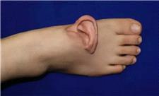 پزشکان چینی در موردی بی‌سابقه، گوش بیمار را به پایش پیوند زدند