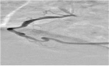 امکان افزایش دقت نمایش عروق کرونری قلب با روش‌های مبتنی بر هوش مصنوعی