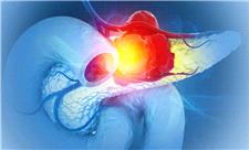 امید تازه برای درمان مقاوم‌ترین سرطان؛ دانشمندان تومورهای پانکراس را در موش‌ها نابود کردند