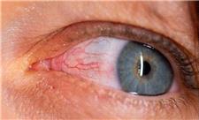 باکتری پنهان در چشم، احتمالاً محرک بیماری آلزایمر است