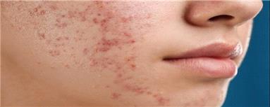 درمان جدید آکنه از راه رسید