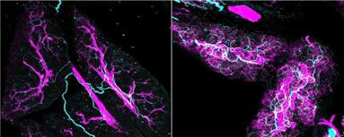 اعصاب، همدست پنهان سرطان لوزالمعده