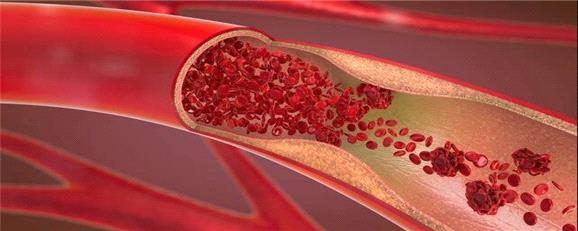 کاهش چشمگیر چربی خون با یک داروی جدید