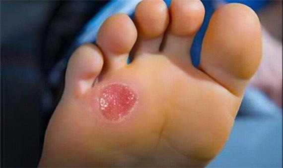 ترمیم زخم‌های دیابتی با سلول‌های بنیادی و فیبروبلاست