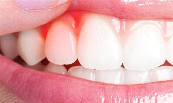 کیفیت خواب ضعیف، رهاورد بیماری‌های لثه