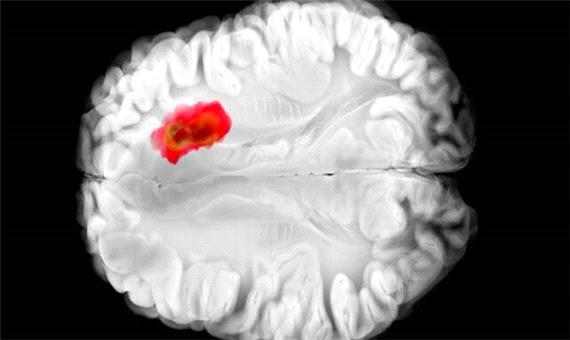 کشف دارویی برای مبارزه با کشنده‌ترین سرطان‌های مغز