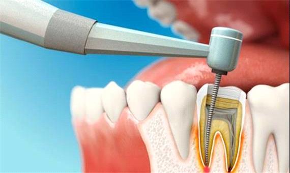 عصب‌کشی درد دارد اما سپر قلب‌تان است!