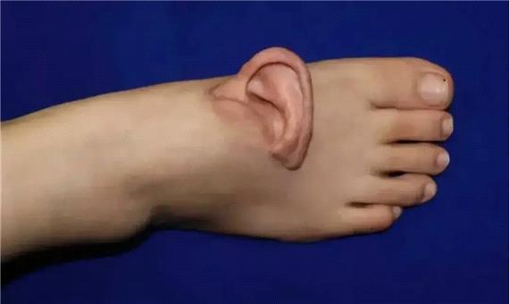 پزشکان چینی در موردی بی‌سابقه، گوش بیمار را به پایش پیوند زدند