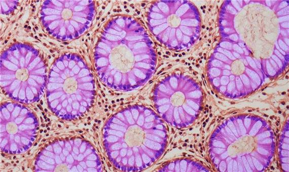 چگونه التهاب و کمبود آهن رانش پیری در روده را تسریع می‌کند