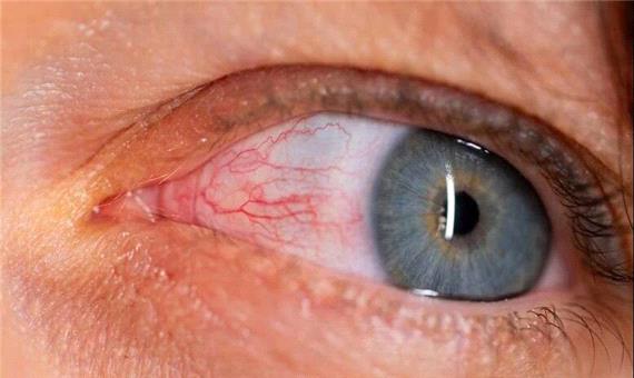 باکتری پنهان در چشم، احتمالاً محرک بیماری آلزایمر است