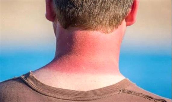 تنها یک آفتاب‌سوختگی شدید می‌تواند سلامت ما را برای همیشه تغییر دهد