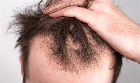ماینوکسیدیل خوراکی برای ریزش موی مردانه موثرتر است | آخرین خبر