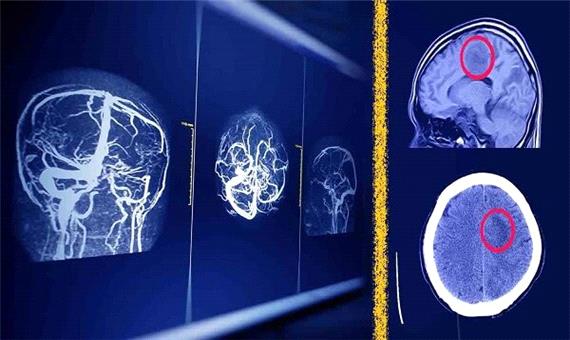 راهکار پژوهشگران دانشگاه تهران برای امنیت هوش مصنوعی در MRI مغز