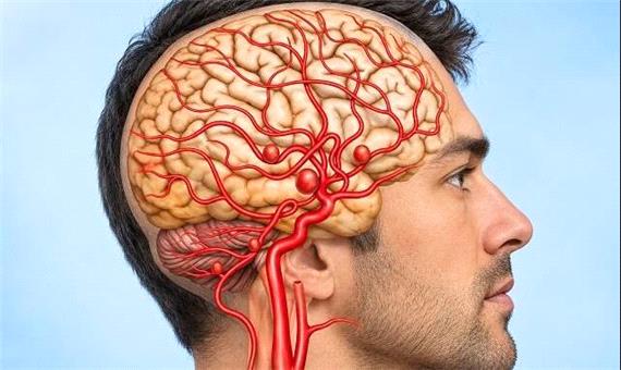 AI و افزایش 40 درصدی موفقیت رادیولوژیست‌ها در شناسایی «ضایعات عروقی مغز»